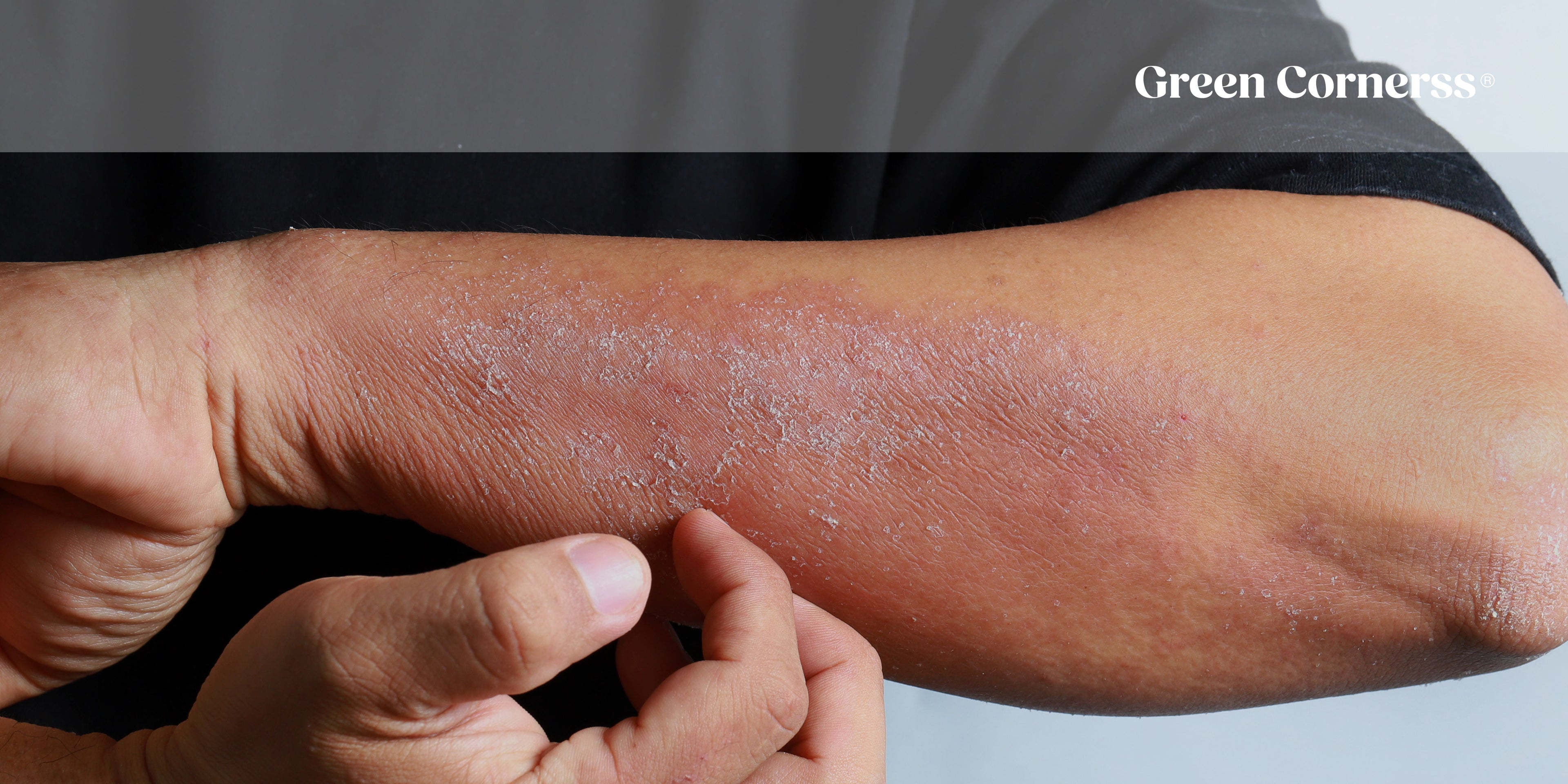¿Qué es la dermatitis atópica? Guía completa para entender esta enfermedad de la piel