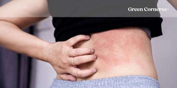 ¿El sudor empeora la dermatitis? Causas, consejos y soluciones