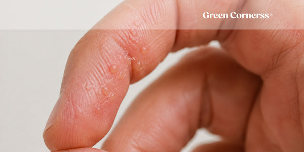 Dishidrosis en manos y pies: Qué es, síntomas, causas y tratamiento