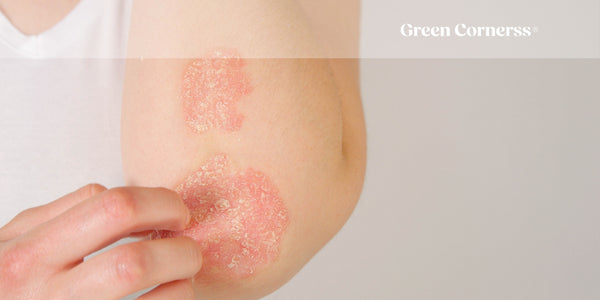 Psoriasis: Qué es, cómo empieza, síntomas, tipos y tratamiento