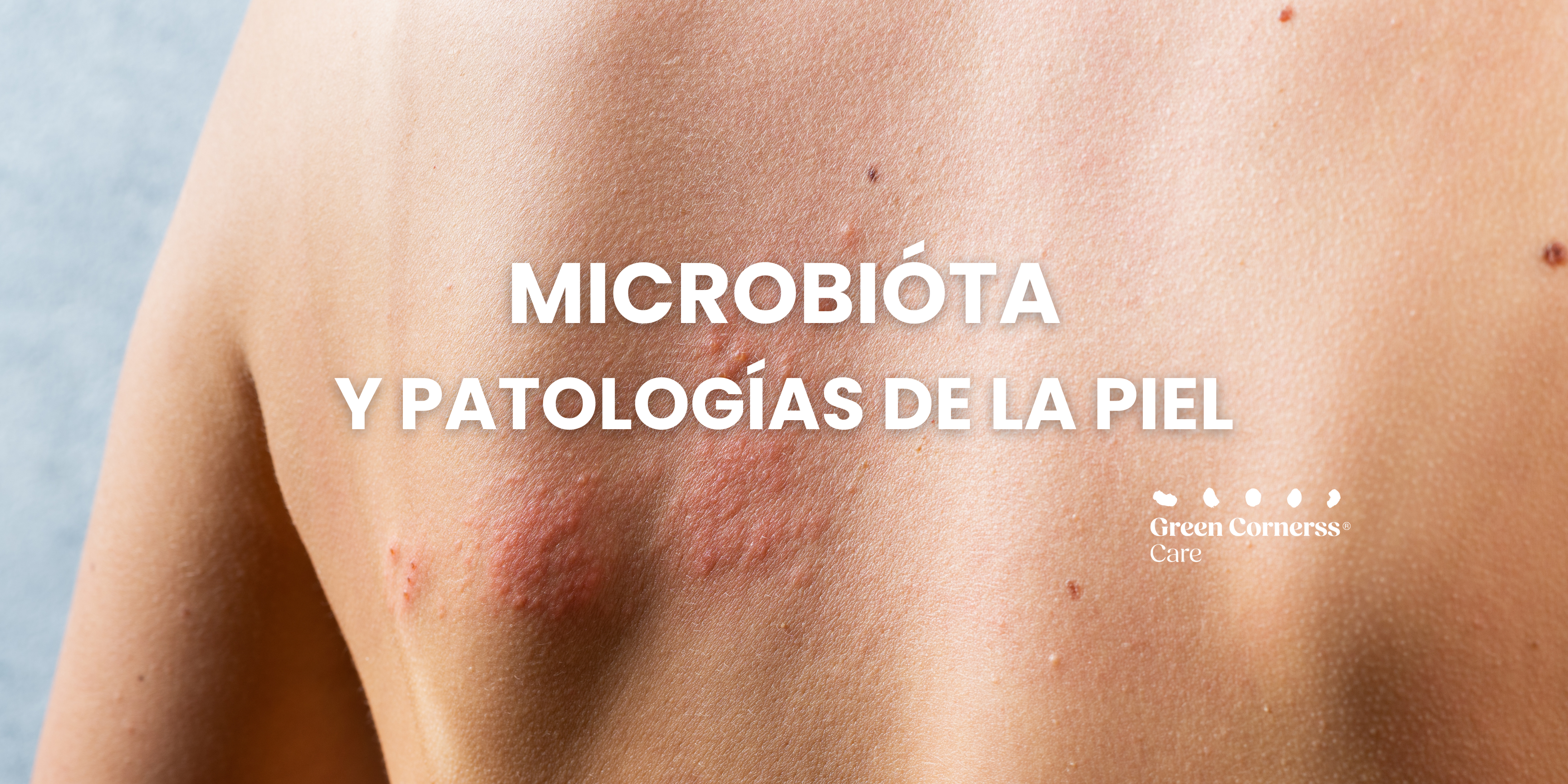 Microbiota y Patologías de la Piel: ¿Cuál es la Relación?