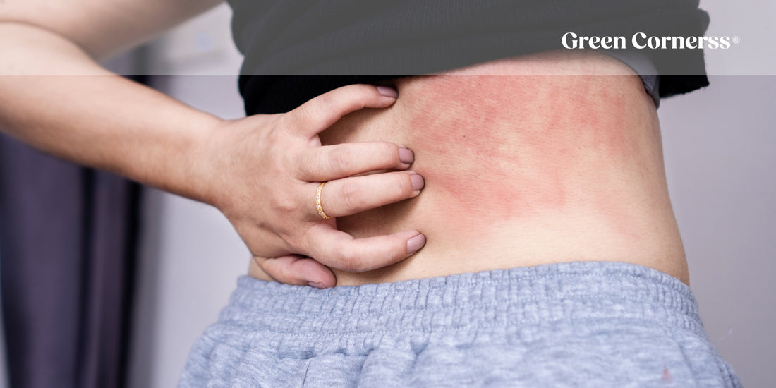 Dermatitis atópica en verano: cómo evitar los brotes y cuidar tu piel